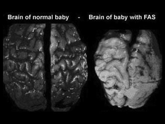 Brain of baby with FAS.